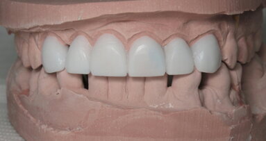 Le  mock-up, un outil quotidien en esthétique dentaire