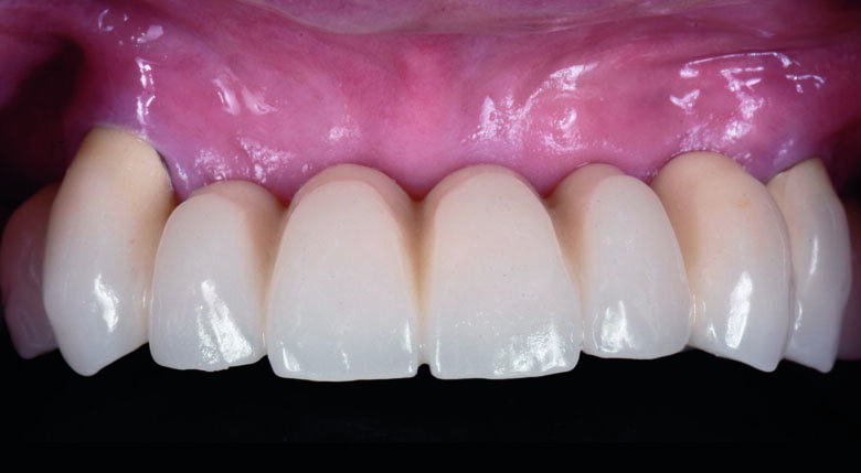 Fig 2. Pre-operative without AGV