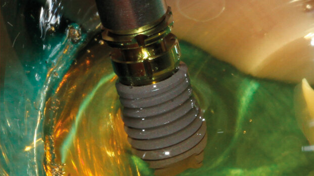 Il trattamento implantoprotesico nei pazienti  con osteoporosi in terapia con bifosfonati orali