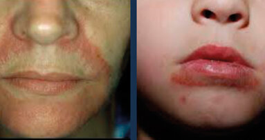 Dermatite periorale? Un’arma terapeutica in più con i trattamenti integrati