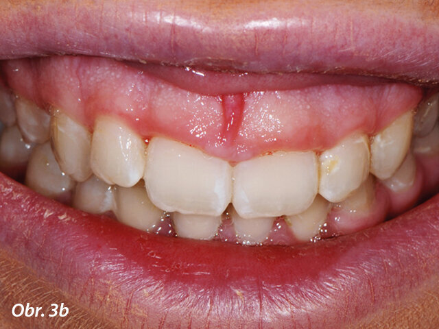 Po ortognátní chirurgii.