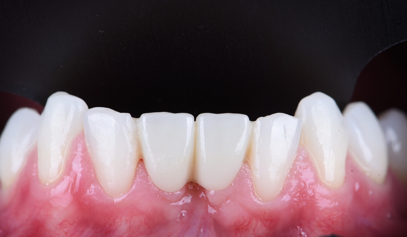 Fig. 11: Clinical situation 18 months after definitive placement.