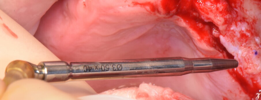 Figg. 18, 19 - Inserimento del demo.