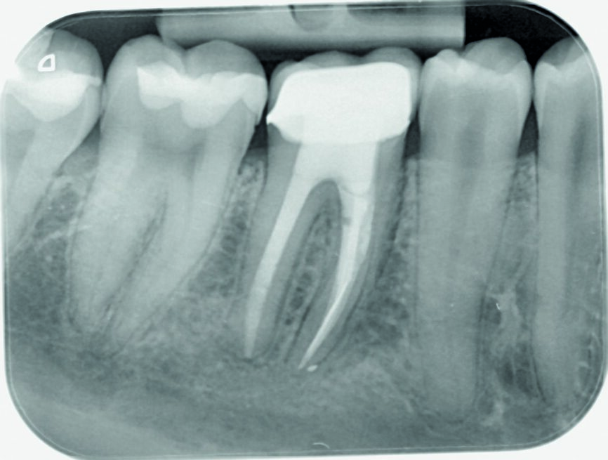 Fig. 6: Control radiograph after one month