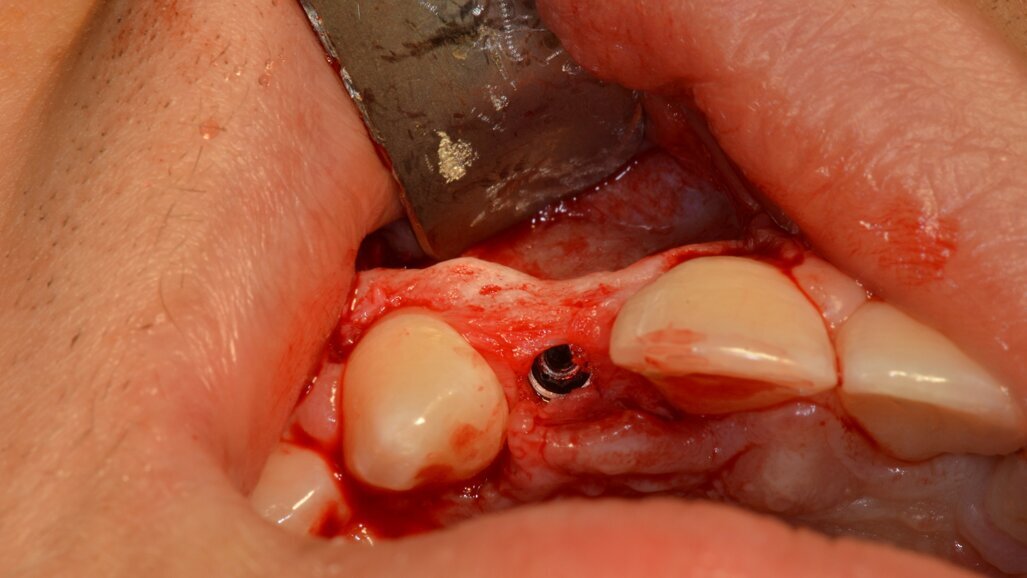 Alveolar deficiency management in lateral upper incisor agenesis