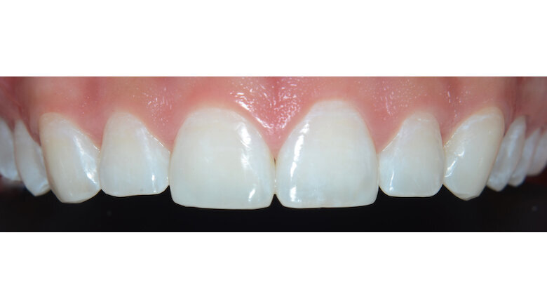 Foto 11. Imagen después de las reconstrucciones de los bordes incisales de los centrales y caninos con Resina Forma.
