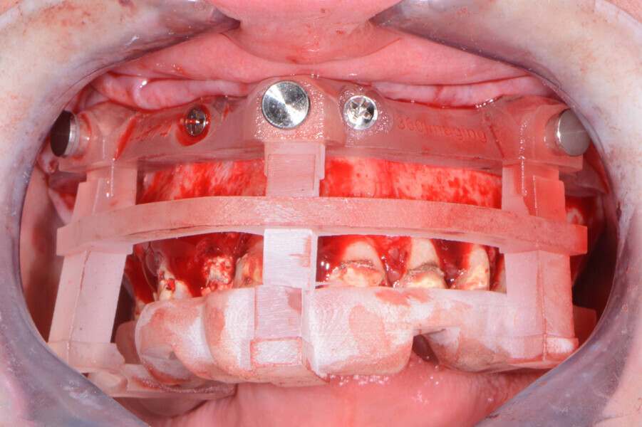 Fig. 6: Positioning guide.
