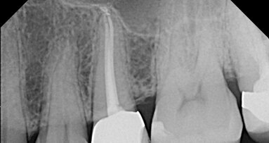 AAE uses Root Canal Awareness Week to dispel myths