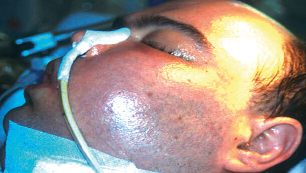 Le infezioni post-operatorie nella chirurgia odontoiatrica