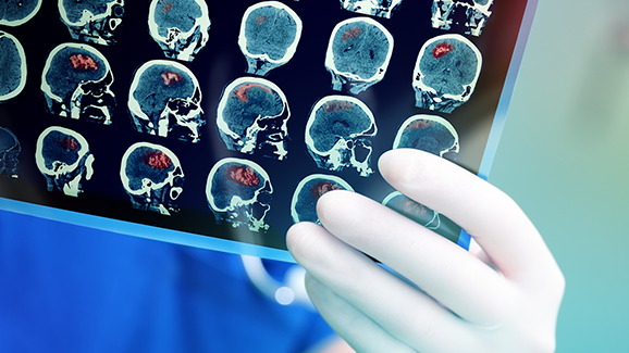 Schlechte Zahngesundheit birgt Risiko für Schlaganfälle