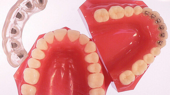 Simpli5: the next generation in invisible orthodontic therapy