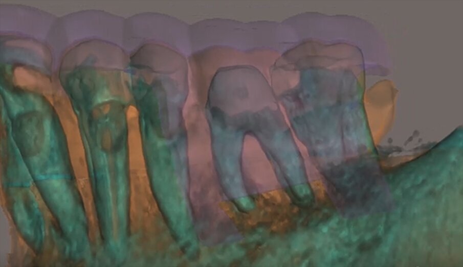 A template that marked the limits of a cortical window to accurately reach the apical area of both roots was designed (d).