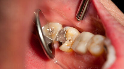 La Commission européenne étudie les aspects environnementaux du mercure dans les amalgames dentaires