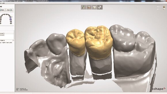 Timski igrači: efikasnost i estetika  -  Nadoknade pune morfologije napravljene od translucentnog cirkonijum-dioksida