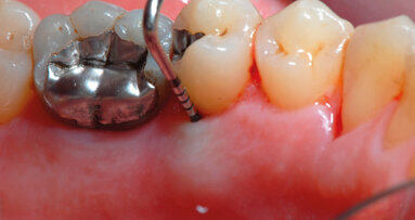 Il laser a Diodo non funziona come monoterapia. Caso clinico