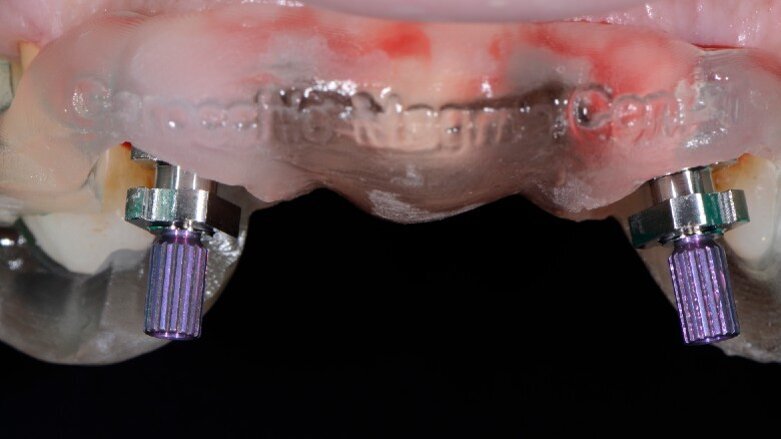 Flusso digitale e provvisorio post-chirurgico: nuova procedura clinica per il carico immediato