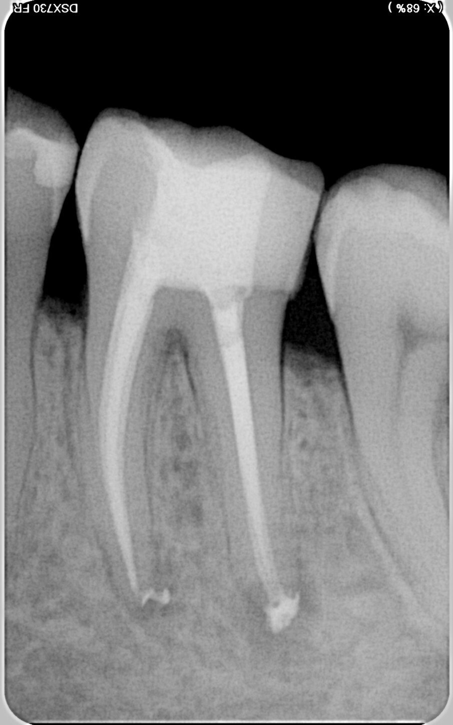 Fig. 5: Post-op radiographic images. (Image: © Dr Silviu Bondari)