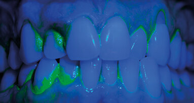 Lo sbiancamento professionale, forza trainante nella concordance sul miglioramento del controllo del biofilm batterico domiciliare