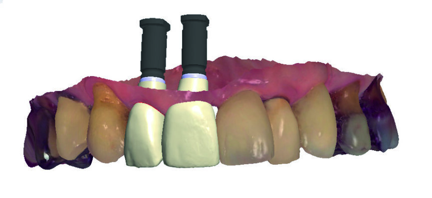 Figs. 5a et b : Design des couronnes provisoires virtuelles et leur piliers provisoires en transparence. 