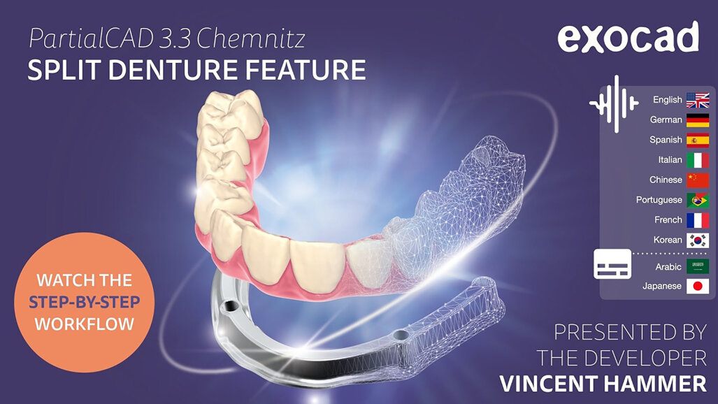 exocad – PartialCAD 3.3 Chemnitz - Split denture feature