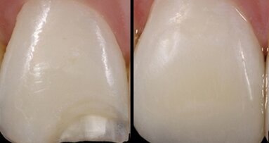 El experto en estética Luiz Rafael Calixto sobre la planificación de las restauraciones indirectas