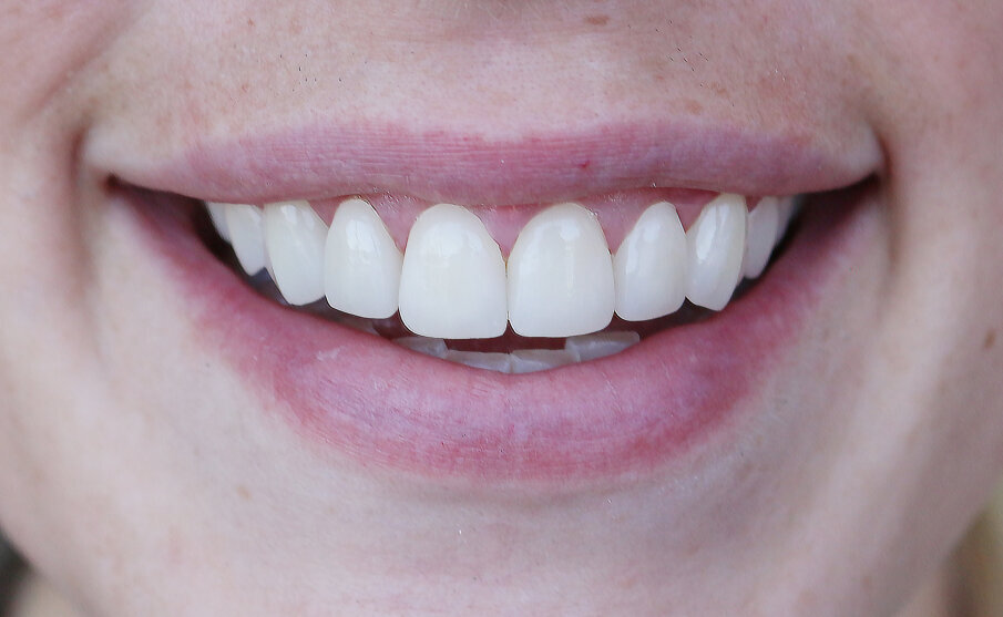 Fig. 5: Final posed smile.