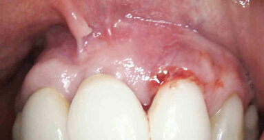 Efficace trattamento di un caso di perimplantite con laser Nd:YAG. Caso clinico