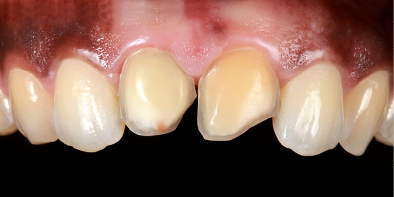 Fig. 17: As the result was esthetically unsatisfactory, the teeth were prepared using a planned, minimally invasive procedure.