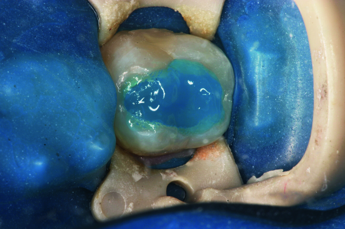 Fig. 5 : Mordançage total de la cavité.