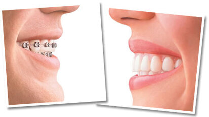 Υποτροπή του συνωστισμού των κάτω προσθίων δοντιών μετά την ορθοδοντική θεραπεία