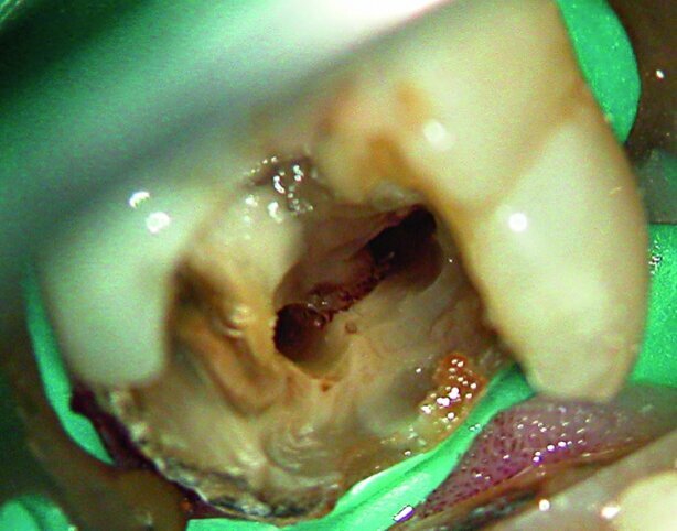 Fig. 3: Debris accumulated after preparation in the isthmus between the mesial canals of a lower molar.