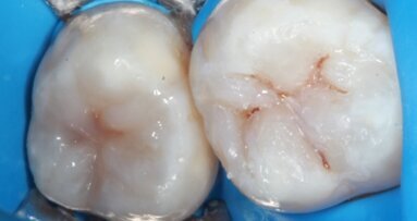 Funkcjonalna odbudowa estetyczna w odcinku bocznym – opis przypadku