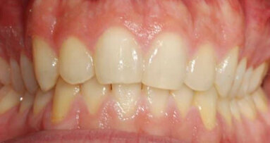 Valutazione clinica dello sbiancamento combinato post Invisalign: case report