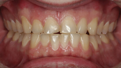 Conservative and necessary: How occlusion can affect a single-tooth replacement