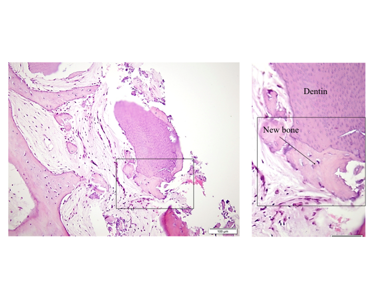 Figs. 13a & b: Histological images showing new bone formation in close contact with dentine particles.