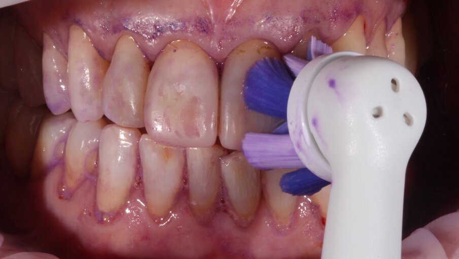 Fig. 1 - Testina Ultimate Clean.