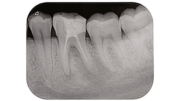 Un’innovativa sistematica per il ritrattamento ortogrado dei canali radicolari: Endo Re-Start (Komet)