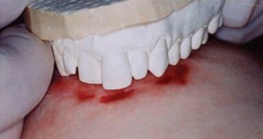 Os pesquisadores argumentam que é tempo de parar de usar as marcas de mordida em medicina forense