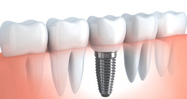Zur Lage der Implantologie in der Schweiz