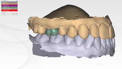 A biomimetic approach to restoration after endodontic treatment