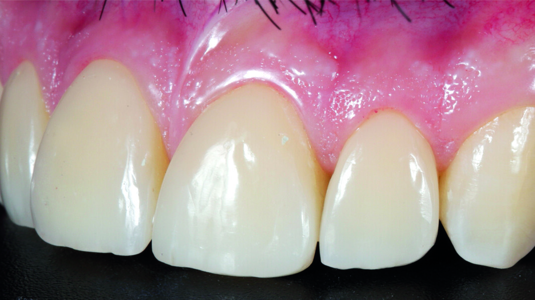 Fig. 20: Final result, left lateral view.