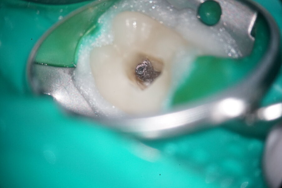 Fig. 4: Initial situation of distal canals.