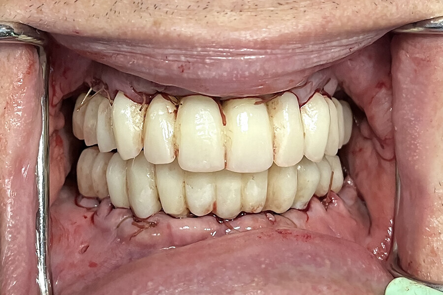 Fig. 14a: Retracted view of the provisional restorations (a) fabricated with C2F small hole technology (b). Two-week post-op smile (c). Two-week post-op panoramic radiograph and intra-oral photograph showing excellent healing (d & e).