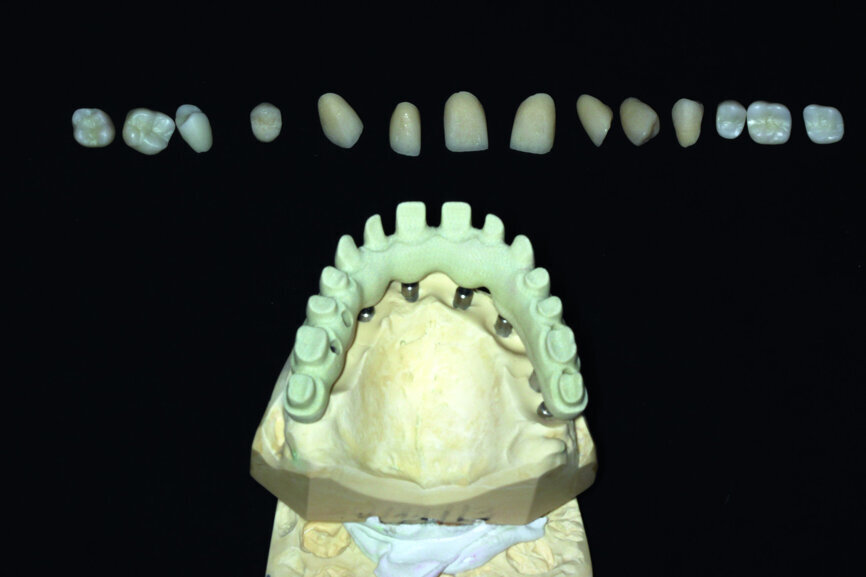Fig. 13: Porcelain crowns prepared for testing.