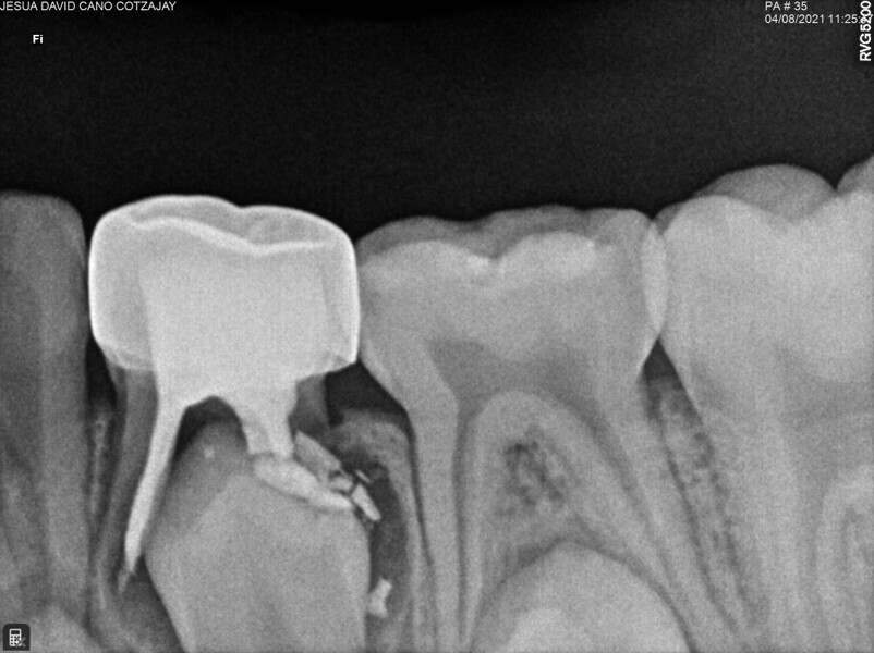 Fig. 12 : Contrôle à 36 mois montrant l’évolution normale du processus éruptif malgré la lente résorption du ciment à l’oxyde de zinc eugénol.
