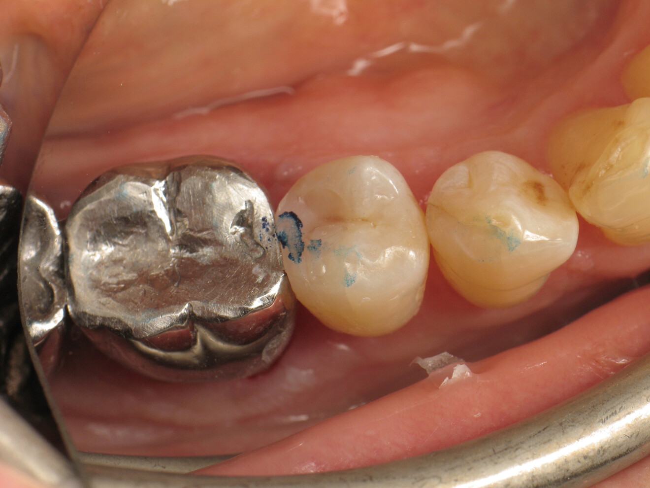 Fig. 20: Occlusion check before adjustments.