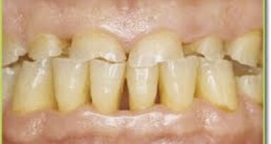 Terapias para el bruxismo