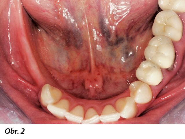 Radiologické a klinické vyšetření odhalilo omezenou dostupnost kosti.