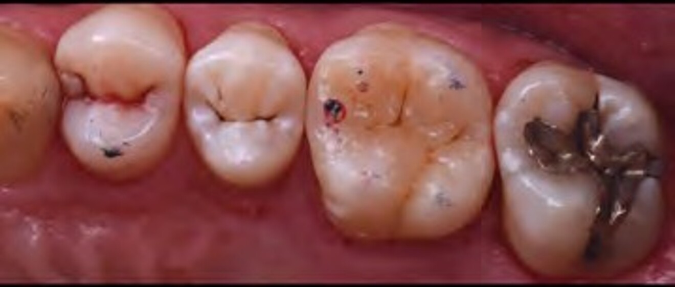 Fig. 3a: Immediate postoperative occlusal view demonstrating the completed direct composite restorations with restored anatomical form and occlusal morphology. 