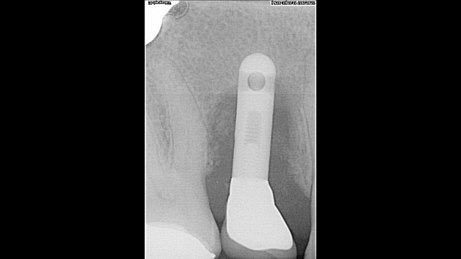 Zvětšený záběr
z RTG snímku.